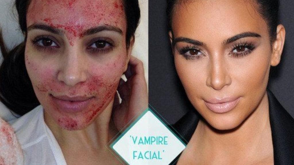 Vampire Facial